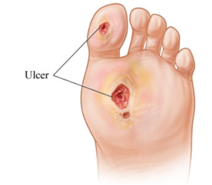 diabetic-foot-ulcers